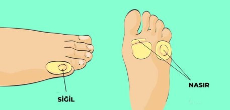 Siğil ve Nasır Arasındaki Farklar